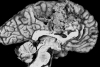 Organizing infarct, anterior cerebral artery distribution